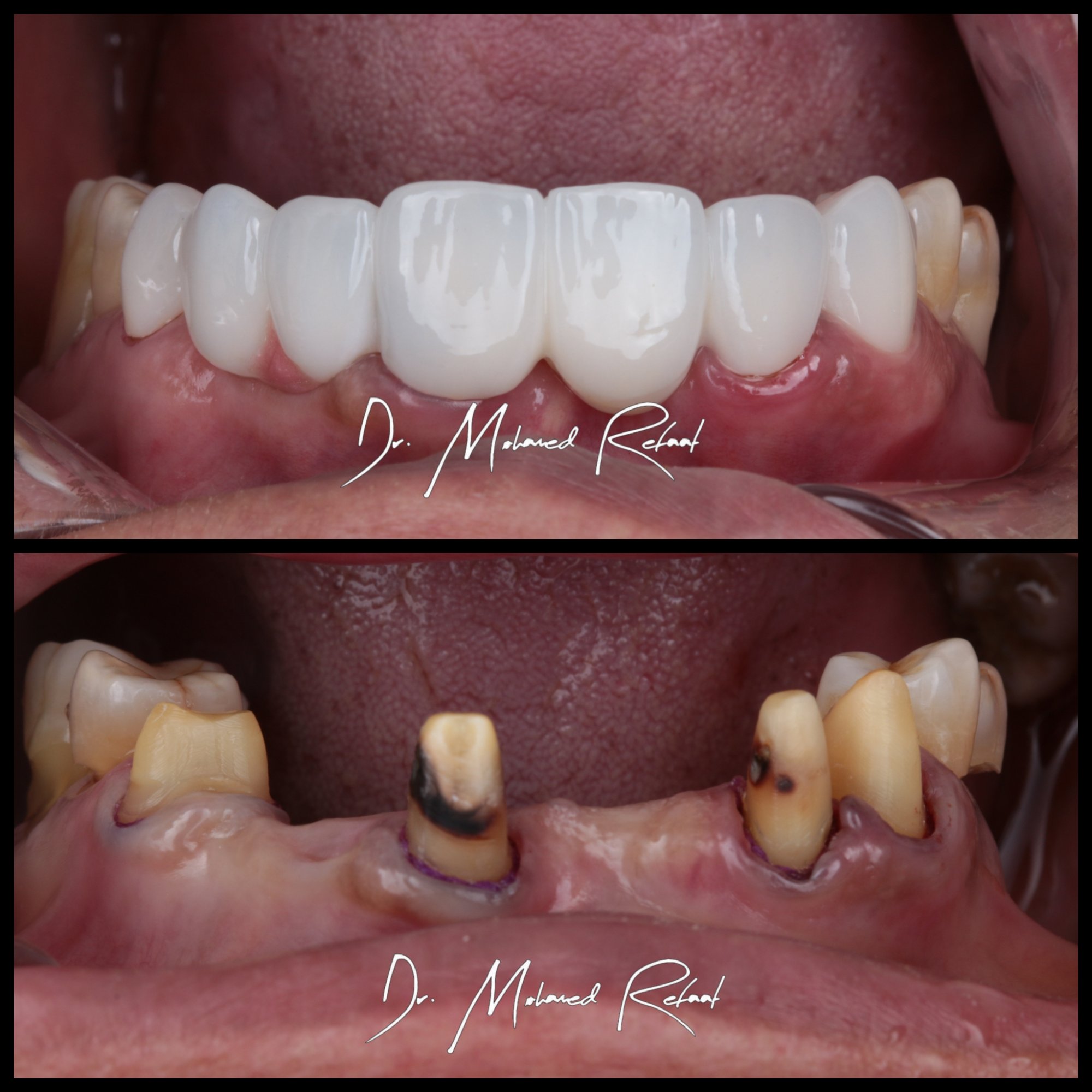 Full mouth rehabilitation