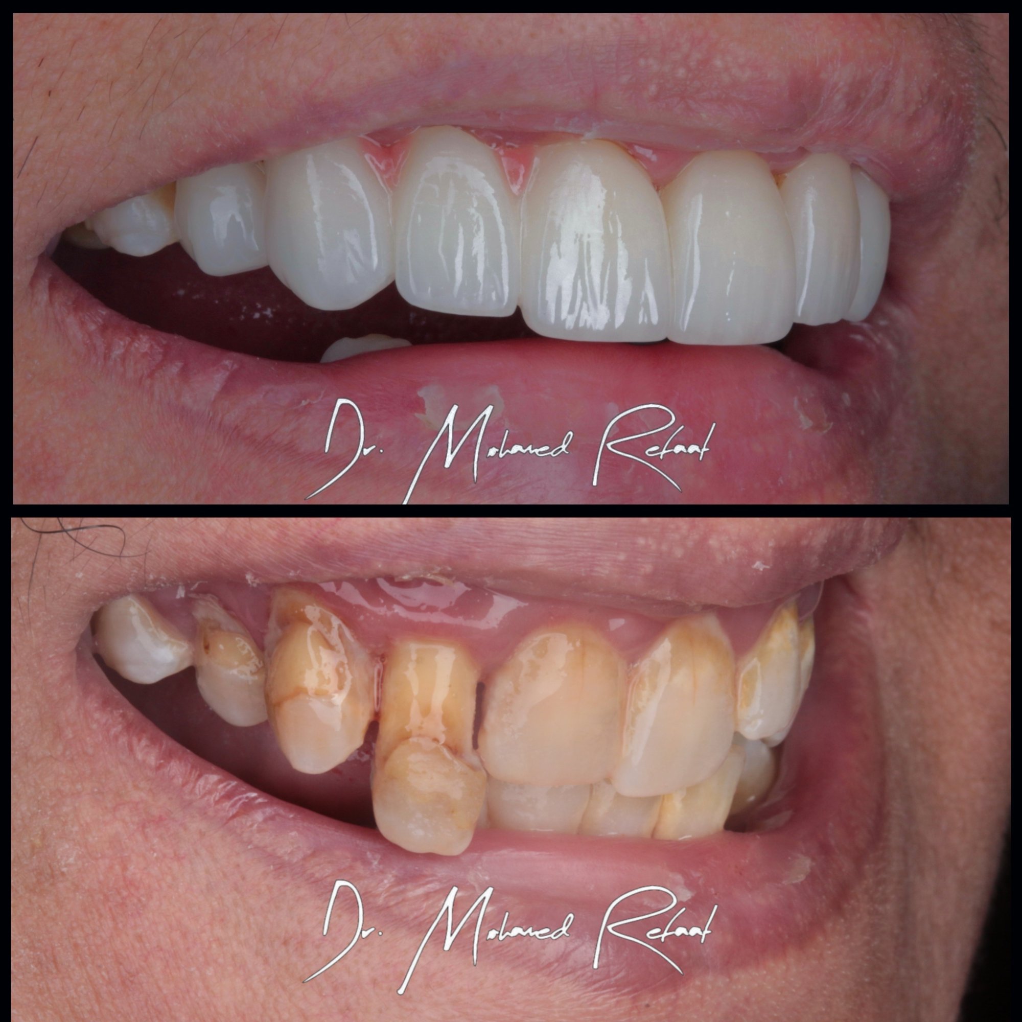 Emax veneers